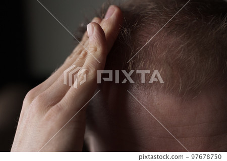 Men hair loss problem alopecia Men hair loss problem alopecia 97678750