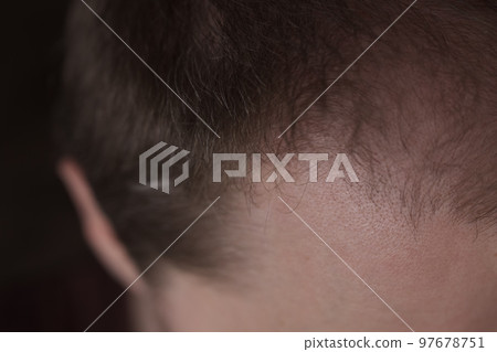 Men hair loss problem alopecia 97678751