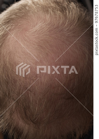 Men hair loss problem alopecia 97678753