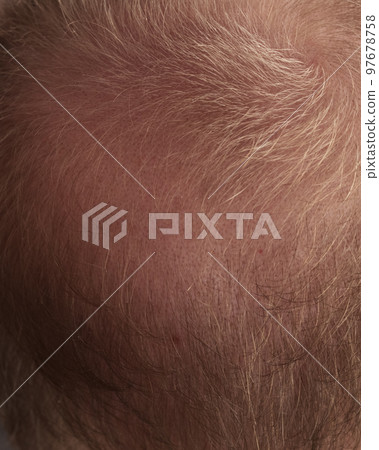 Men hair loss problem alopecia 97678758
