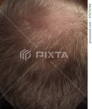 Men hair loss problem alopecia Men hair loss problem alopecia 97678760