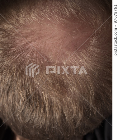 Men hair loss problem alopecia Men hair loss problem alopecia 97678761