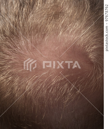 Men hair loss problem alopecia Men hair loss problem alopecia 97678762