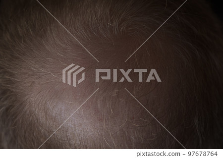 Men hair loss problem alopecia Men hair loss problem alopecia 97678764