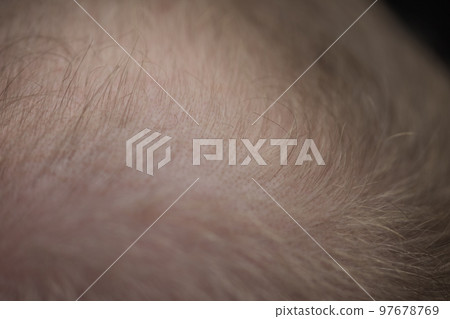 Men hair loss problem alopecia Men hair loss problem alopecia 97678769