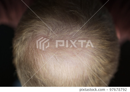 Men hair loss problem alopecia 97678792