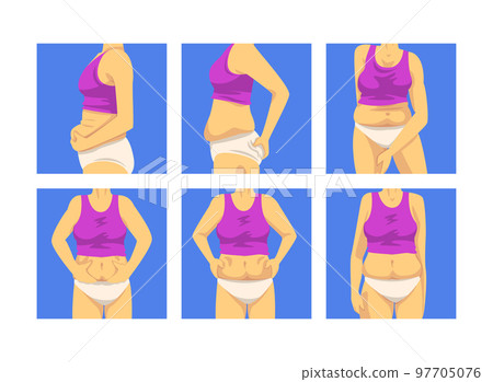 Female Torso with Sagging Belly and Soft Muscles Vector Set Female Torso with Sagging Belly and Soft Muscles Vector Set 97705076