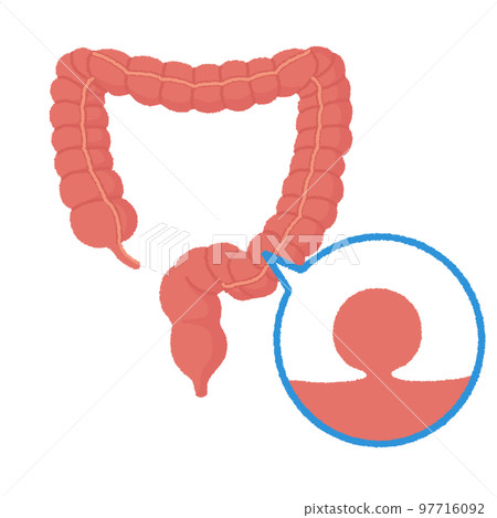 Illustration of colon polyps 97716092