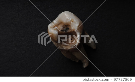 Tooth decay on black background. Macro shot of a decayed teeth till root after extraction of dentist. Real tooth anatomy due lack of care. Top view of caries teeth texture on black paper. Dental care. 97727869