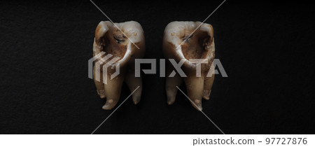 Tooth decay on black background. Macro shot of a decayed teeth till root after extraction of dentist. Real tooth anatomy due lack of care. Top view of caries teeth texture on black paper. Dental care. 97727876