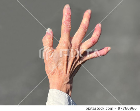 老婦手背結霜 97760966