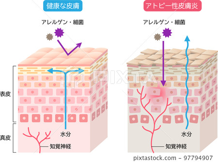 Atopic dermatitis and healthy skin Skin cells and cross-sectional view 3D 97794907