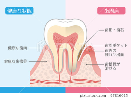 Tooth illustration _ periodontal disease 97816015