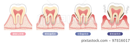 Tooth illustration_progression of periodontal disease 97816017