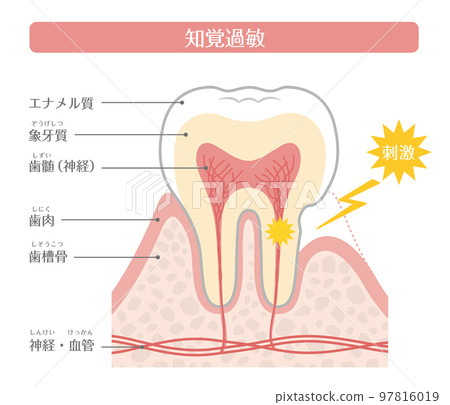 Tooth illustration_Hypersensitivity - Stock Illustration [97816019] - PIXTA