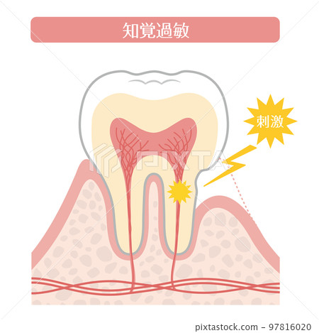 牙齒插圖_過敏 牙齒插圖_過敏 97816020