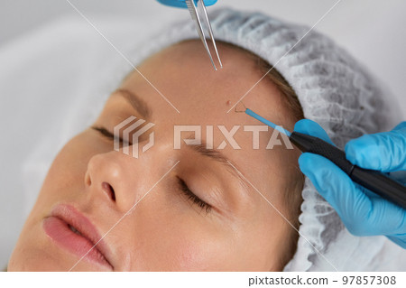 Removal of birthmark from client forehead closeup shot Removal of birthmark from client forehead closeup shot 97857308