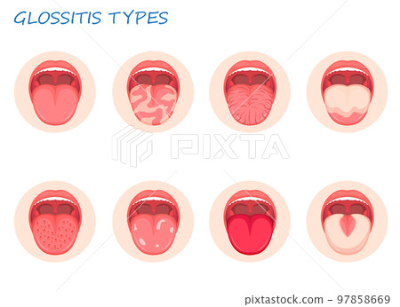 Types glossitis. Inflammatory disease tongue, vector illustration 97858669