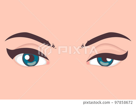 Ptosis of the upper eyelid, optical problem with eye, medical vector illustration 97858672