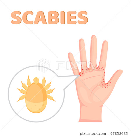 Sarcoptes scabiei. scabies. Sexually transmitted disease. Infographics. illustration on isolated background. Sarcoptes scabiei. scabies. Sexually transmitted disease. Infographics. illustration on isolated background. 97858685