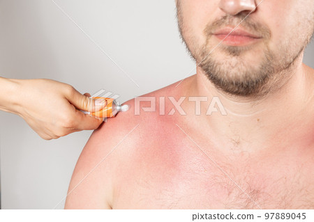 Applying therapeutic ointment to the skin of a person with a sunburn, close-up. 97889045