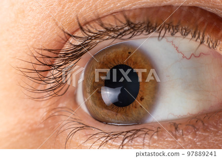 Keratoconus of eye, 4th degree. Contortion of the cornea in the form of a cone, deterioration of vision, astigmatism. Macro close up 97889241