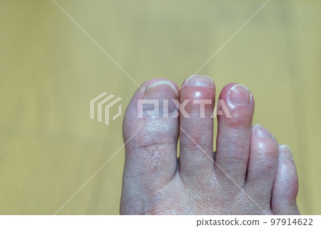 腳趾凍傷小貼士 97914622