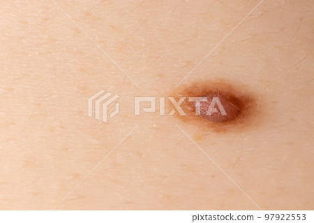 Mole birthmark nevus macro photo on human skin. Close up. Mole birthmark nevus macro photo on human skin. Close up. 97922553