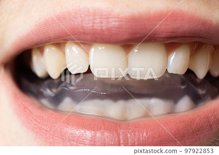 Dental mouthguard, splint in the mouth for the treatment of dysfunction of the temporomandibular joints, bruxism, malocclusion, to relax the muscles of the jaw. 97922853