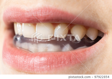 Dental mouthguard, splint in the mouth for the treatment of dysfunction of the temporomandibular joints, bruxism, malocclusion, to relax the muscles of the jaw. 97922854