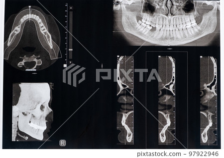 CT scan of a patient with malocclusion, missing chewing tooth and temporomandibular joint dysfunction. 97922946