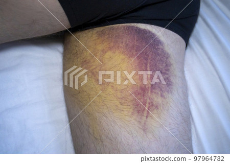 Very large bruise on the inner thigh surface of the man's leg. Accident while playing sports, soccer. Blue, purple, yellow stain on skin. 97964782