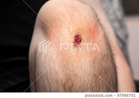 Closeup of fresh wound on man's knee from accident. 97998781