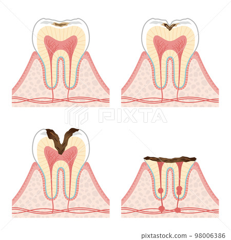 Tooth illustration_progression of tooth decay 98006386