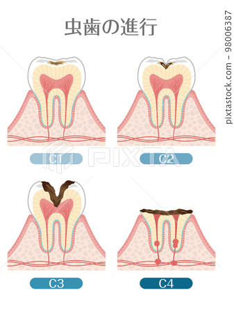 Tooth illustration_progression of tooth decay 98006387