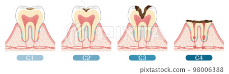 Tooth illustration_progression of tooth decay 98006388
