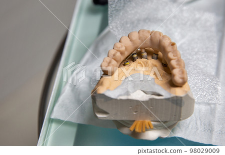 Plastic model of a permanent ceramic-metal dental prosthesis on implants Plastic model of a permanent ceramic-metal dental prosthesis on implants 98029009