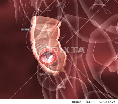 Appendicitis is a painful swelling of the appendix. 98085236