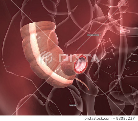 Appendicitis is a painful swelling of the appendix. 98085237