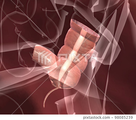 Appendicitis is a painful swelling of the appendix. Appendicitis is a painful swelling of the appendix. 98085239