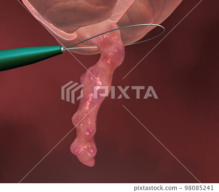 Appendicitis is a painful swelling of the appendix. Appendicitis is a painful swelling of the appendix. 98085241