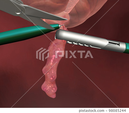 Appendicitis is a painful swelling of the appendix. Appendicitis is a painful swelling of the appendix. 98085244