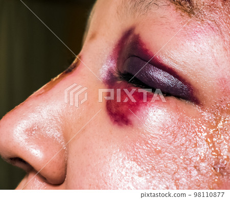 Woman with Black Eye, Shiner. Domestic violence 98110877