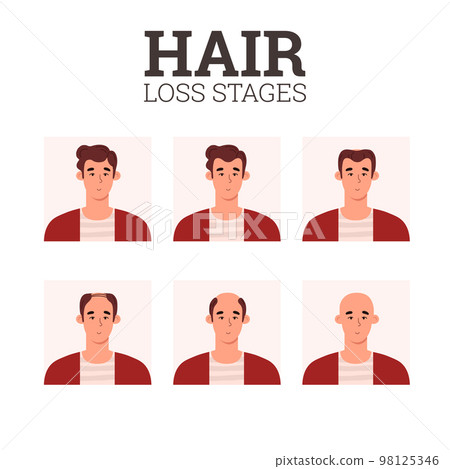 Hair loss stages, alopecia problem infographics - flat vector illustration on white background. Hair loss stages, alopecia problem infographics - flat vector illustration on white background. 98125346