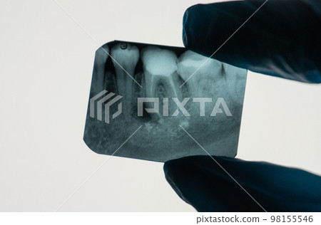 Dental Periapical Granuloma next to tooth root on an X-ray held by a Dentist Dental Periapical Granuloma next to tooth root on an X-ray held by a Dentist 98155546