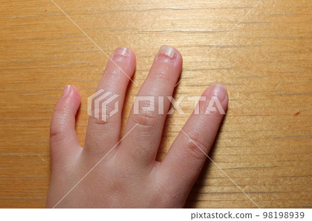 Onycholithiasis after hand-foot-and-mouth disease 98198939