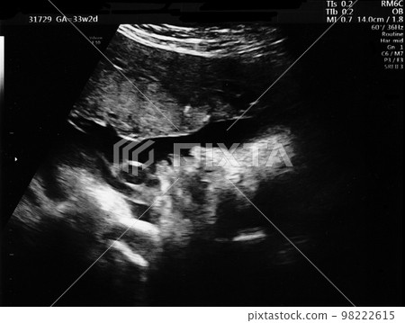 Ultrasound photo of a fetus at 33 weeks of gestation Ultrasound photo of a fetus at 33 weeks of gestation 98222615