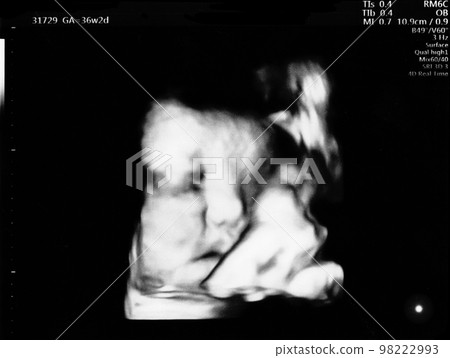 Ultrasound photo of a fetus at 36 weeks of gestation Ultrasound photo of a fetus at 36 weeks of gestation 98222993