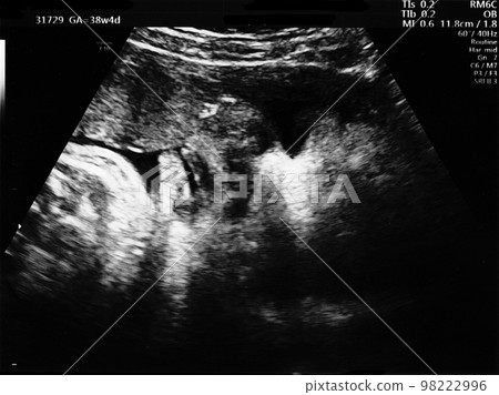 Ultrasound photo of a fetus at 38 weeks of gestation 98222996