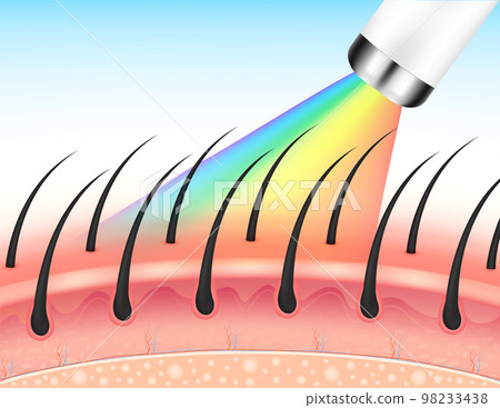 IPL light (Intense Pulsed Light) and Laser hair removal on skin layer leg. Unwanted out make skin smooth. Medical beauty science concept. About cosmetic technology. 3D Realistic vector EPS10. 98233438